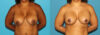 Revision Breast Surgery case #7878 slider thumbnail