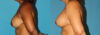 Revision Breast Surgery case #7878 slider thumbnail