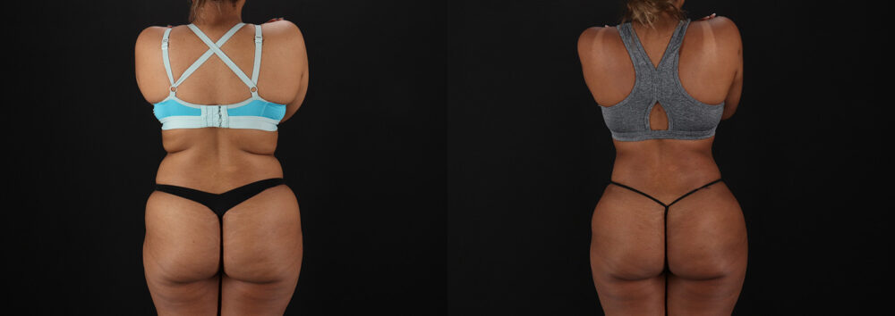 Brazilian Butt Lift case #5513