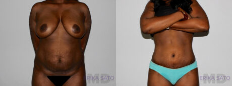 Tummy Tuck case #7094