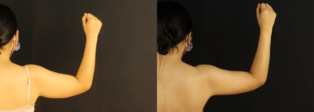 Brazilian Butt Lift case #5170