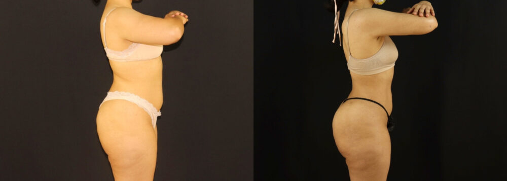 Brazilian Butt Lift case #5170