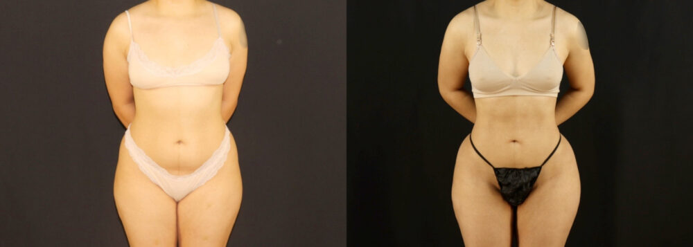 Brazilian Butt Lift case #5170