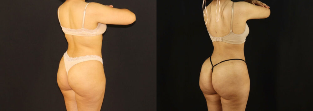 Brazilian Butt Lift case #5170