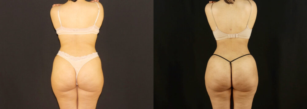 Brazilian Butt Lift case #5170