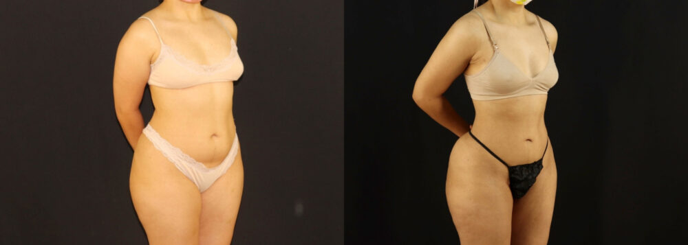 Brazilian Butt Lift case #5170