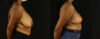 Breast Reduction case #7969 slider thumbnail