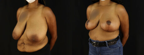 Breast Reduction case #7969