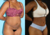 Tummy Tuck case #7277 slider thumbnail
