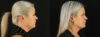 Submental Liposuction case #6948 slider thumbnail