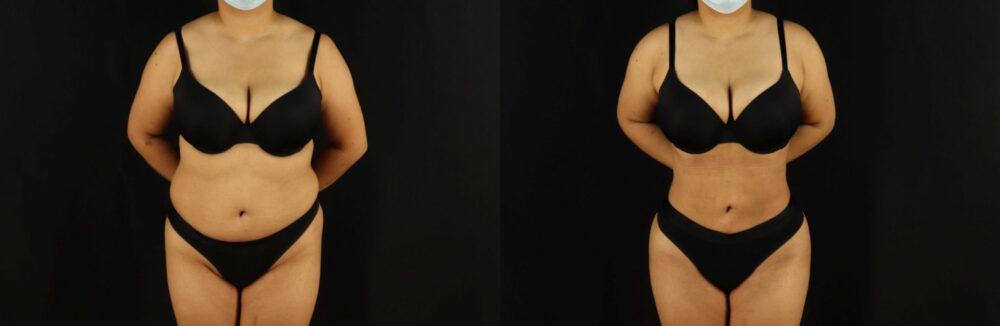 Brazilian Butt Lift case #5173