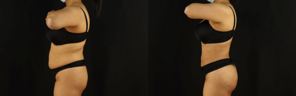 Brazilian Butt Lift case #5173