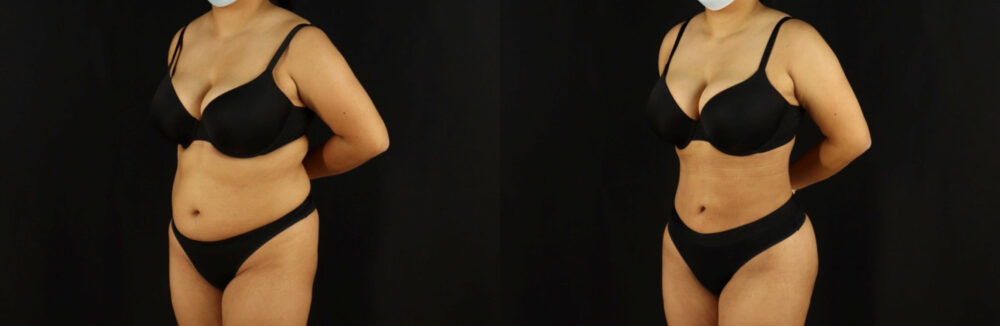 Brazilian Butt Lift case #5173