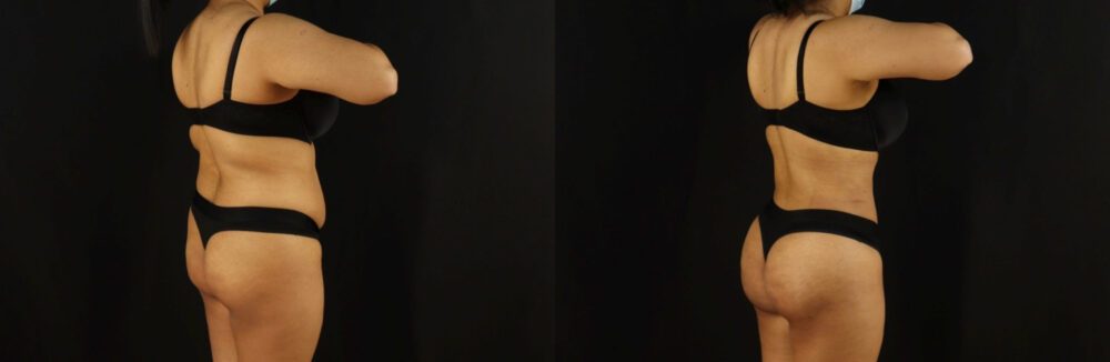 Brazilian Butt Lift case #5173