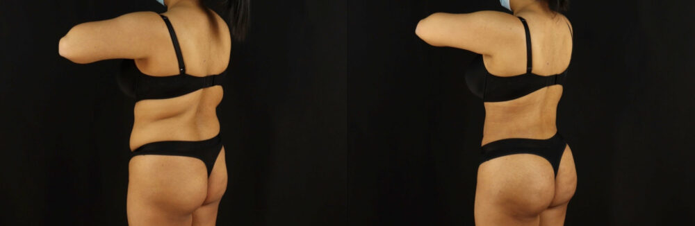 Brazilian Butt Lift case #5173