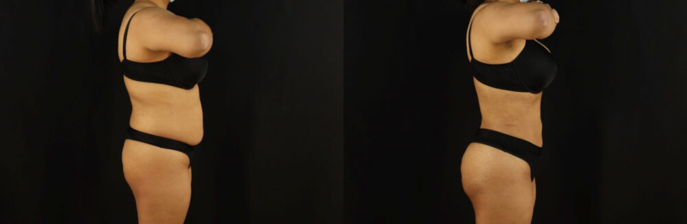 Brazilian Butt Lift case #5173