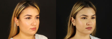 Submental Liposuction case #6949