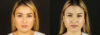 Submental Liposuction case #6949 slider thumbnail