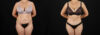 Tummy Tuck case #7462 slider thumbnail