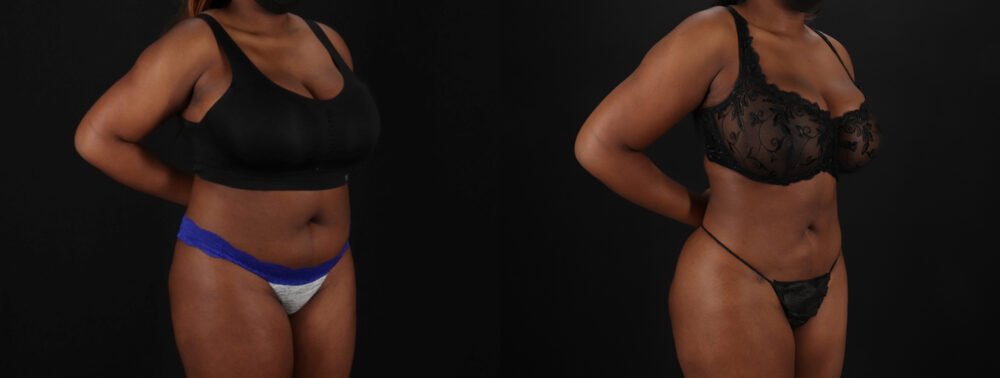 Brazilian Butt Lift case #5265