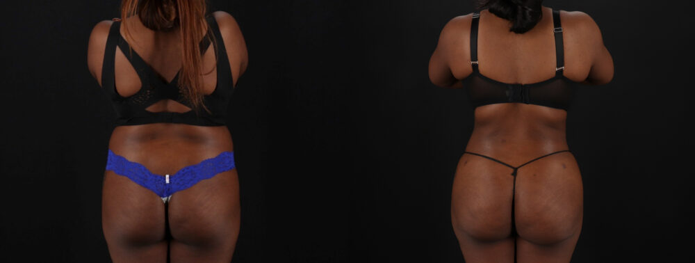 Brazilian Butt Lift case #5265