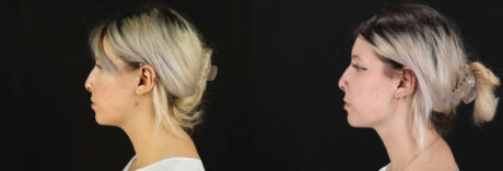 Submental Liposuction case #6951