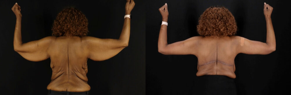 Arm Lift case #6780