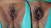 Labiaplasty case #5772 slider thumbnail