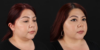 Submental Liposuction case #6952 slider thumbnail