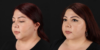 Submental Liposuction case #6952 slider thumbnail