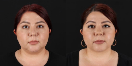 Submental Liposuction case #6952
