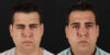 Botox® & Other Neuromodulators case #5038 slider thumbnail