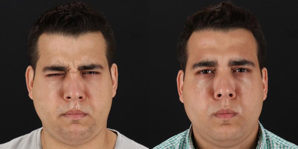 Botox® & Other Neuromodulators case #5038