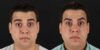 Botox® & Other Neuromodulators case #5038 slider thumbnail