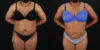 Liposuction case #6015 slider thumbnail