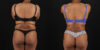 Liposuction case #6015 slider thumbnail