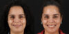 Botox® & Other Neuromodulators case #5034 slider thumbnail