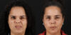 Botox® & Other Neuromodulators case #5034 slider thumbnail