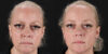 Botox® & Other Neuromodulators case #5030 slider thumbnail