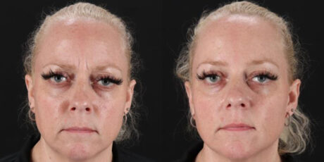 Botox® & Other Neuromodulators case #5030