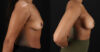 Breast Augmentation case #6390 slider thumbnail