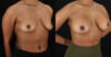 Breast Augmentation case #6390 slider thumbnail