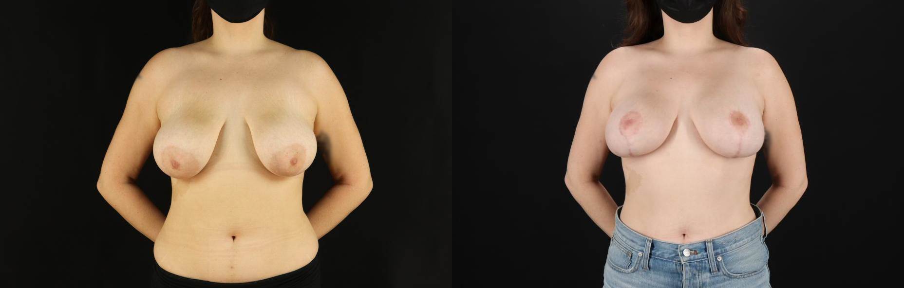12974-48721-Breast-Lift-with-Implants-before-and-after-photo-by-Dr.-Erika-A.-Sato-in-Houston-TX