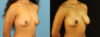 Fat Grafting to the Breast case #256207 slider thumbnail