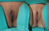 Labiaplasty case #5773 slider thumbnail