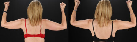 Liposuction case #6017