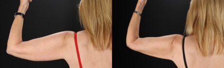 Liposuction case #6017