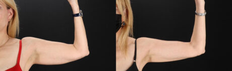 Liposuction case #6017