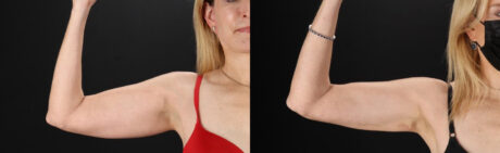 Liposuction case #6017