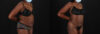 Liposuction case #6016 slider thumbnail